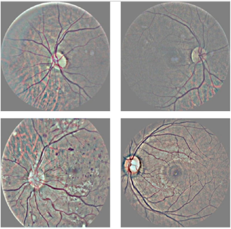 Detection of Diabetic Retinopathy Based on a Convolutional Neural Network Using Retinal Fundus Images