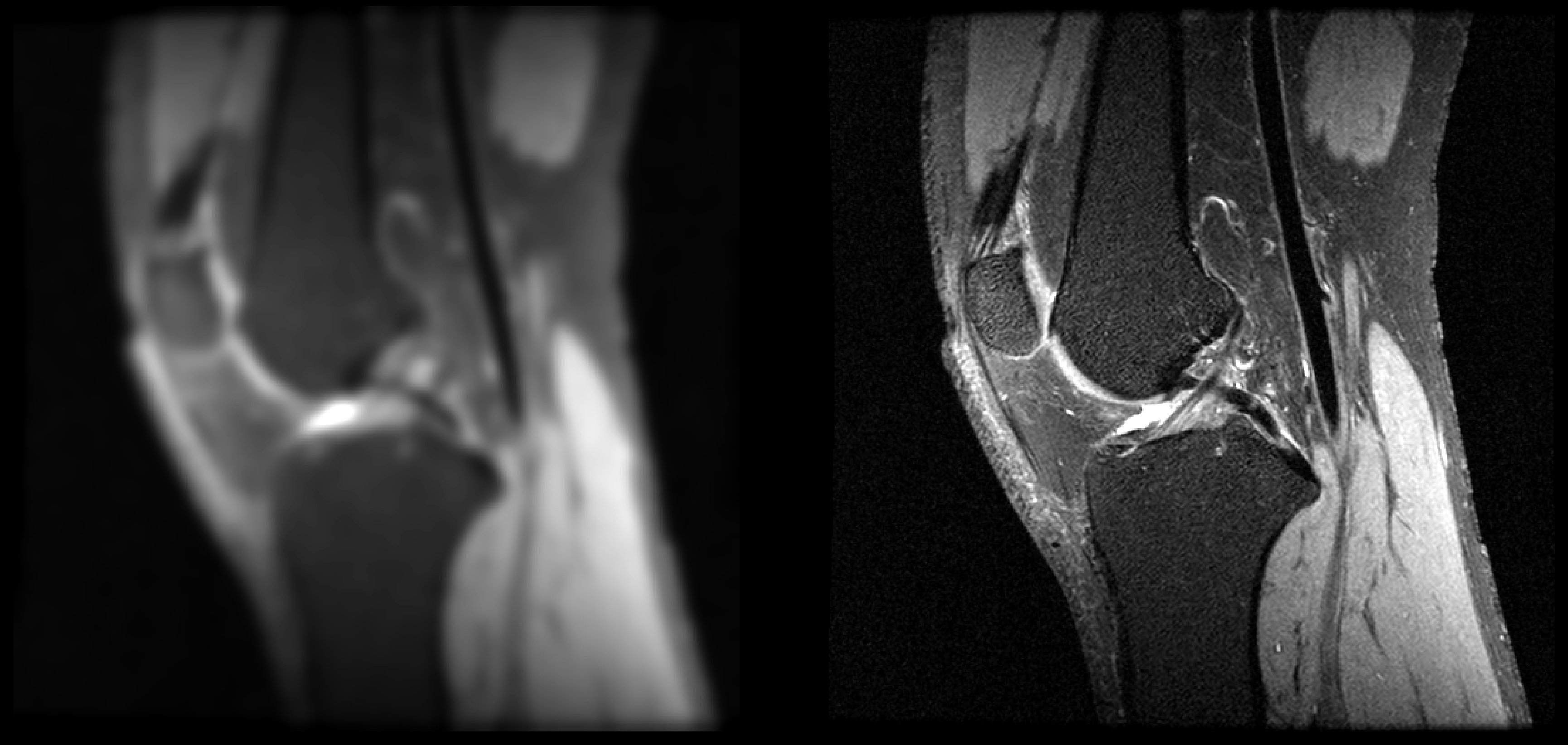 Knee MRI before and after enhancement: degraded input on the left, restored image on the right